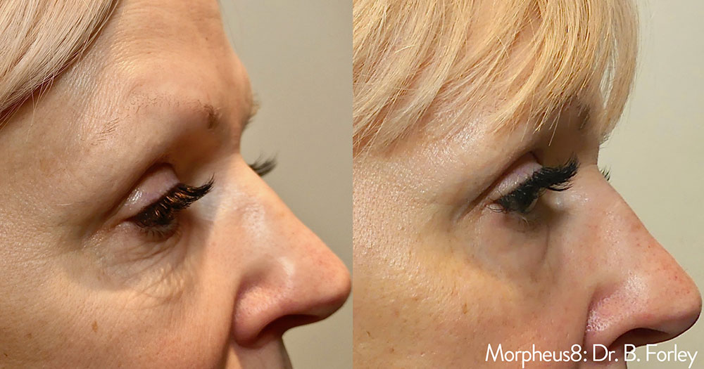 Morpheus8 Before and After Results Photo