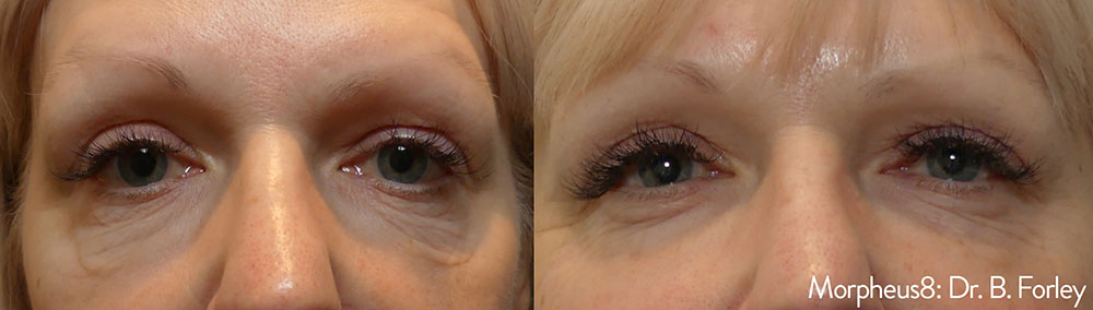 Morpheus8 Before and After Results Photo